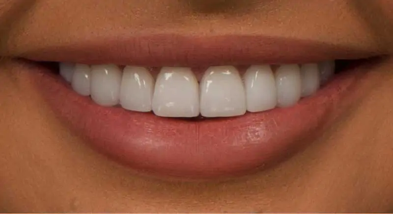 Guide-to-Dental-Veneers-and-Crowns-at-Bali-Sudirman-Medical-Centre