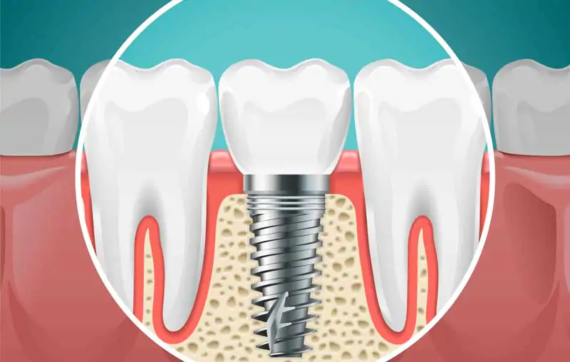 How-Do-You-Care-for-Dental-Implants-A-Comprehensive-Guide-Wallpaper