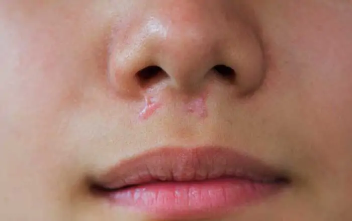 Injeksi-Keloid-Pengertian,-Tujuan,-hingga-Jumlah-Suntikan