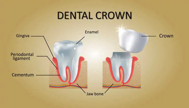 Types-of-Dental-Crowns-and-Cost-Bali-Guide-2025-Wallpaper-4K