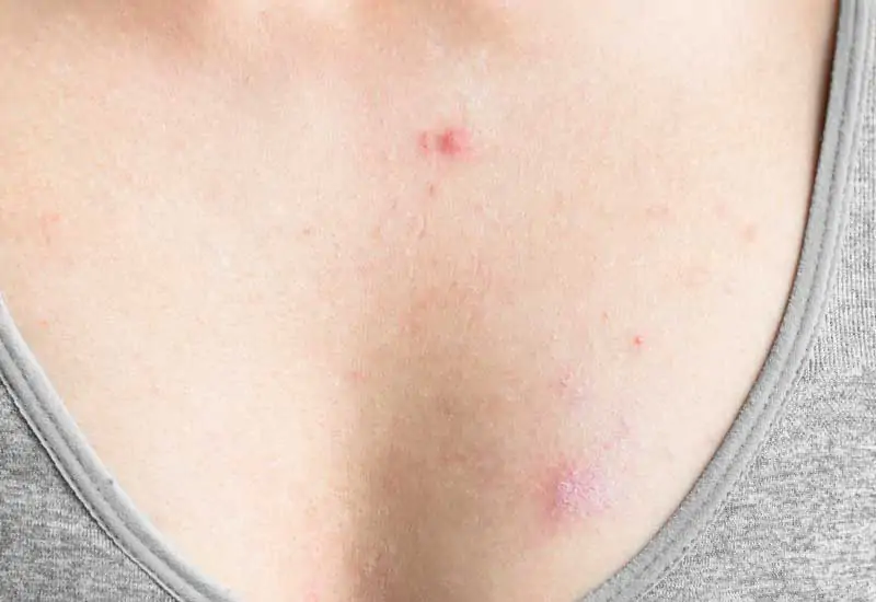 Keloid-Penyebab,-Ciri-Ciri,-dan-Cara-Menghilangkannya-wallpaper