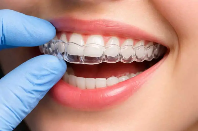 Clear-Aligner-vs.-Braces-The-Ultimate-Guide-to-Your-Perfect-Smile-in-Bali-wallpaper
