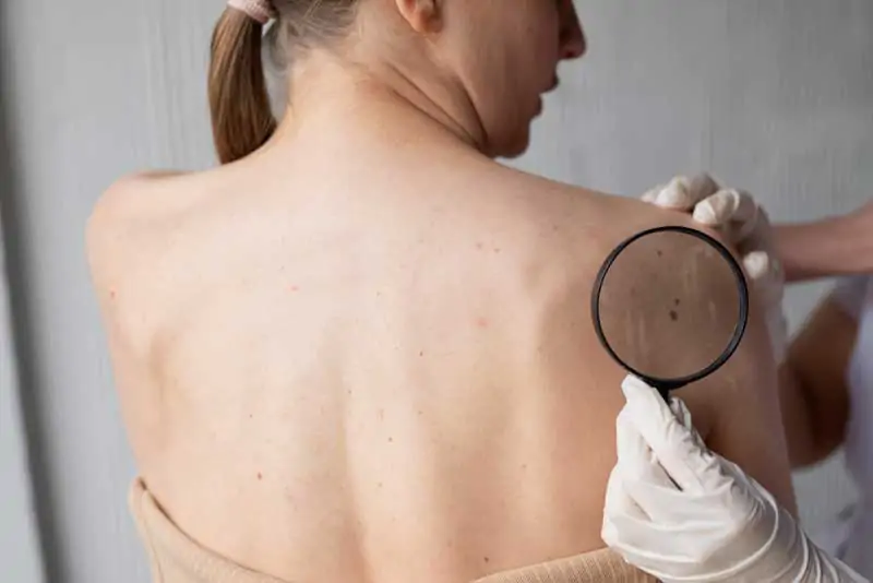 Pantangan-Makanan-untuk-Penderita-Keloid-Guide-2026-wallpaper