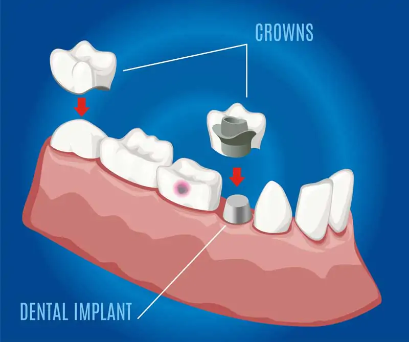 Food-stuck-under-All-on-4-dental-implants