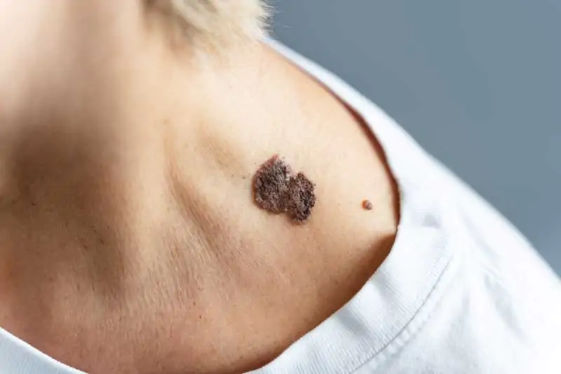 Keloid-muncul-karena-apa-Ini-Penyebabnya!