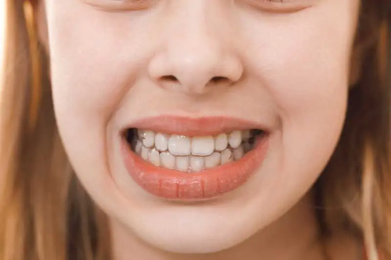 How-to-Fix-Spaced-Teeth-2026