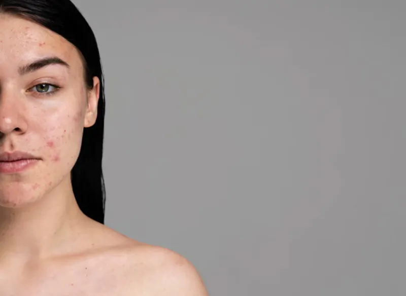 The-Difference-Between-Dirty-Acne-and-Hormonal-Acne-wallpaper