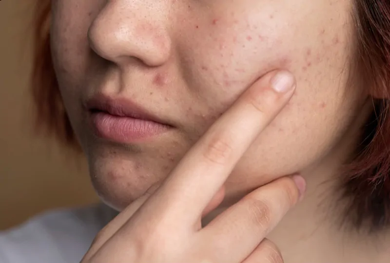The-Difference-Between-Dirty-Acne-and-Hormonal-Acne
