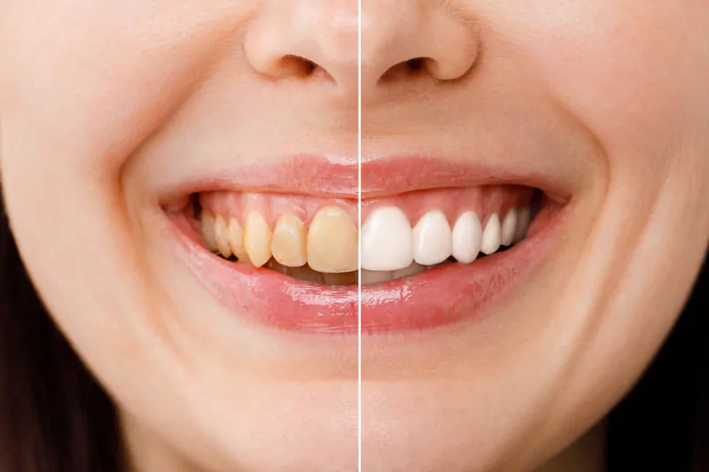 What-is-The-Best-Way-to-Whiten-Teeth-Here’s-the-Ultimate-Answer-wallpaper