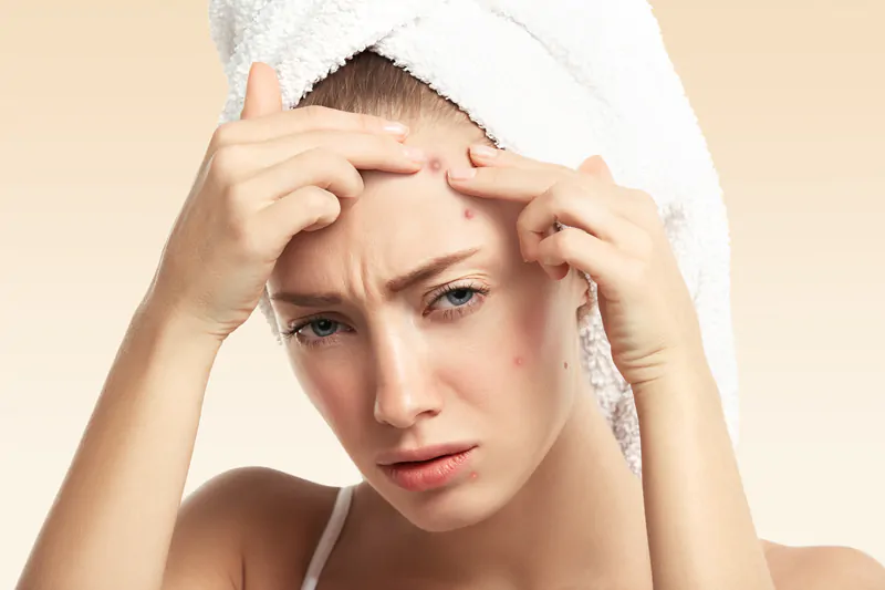 What-is-The-Cause-of-Forehead-Acne-The-Ultimate-Guide