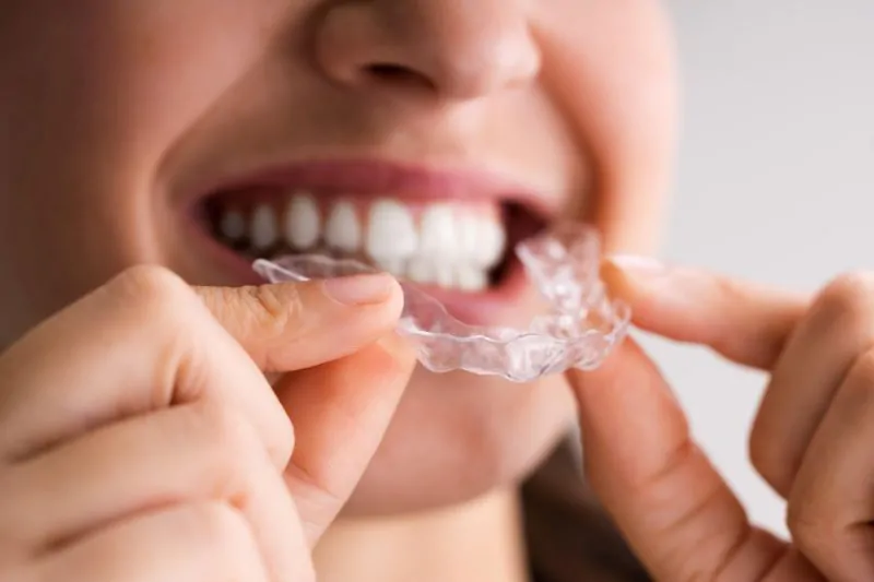 How Clear Aligners Work at Home Guide wallpaper