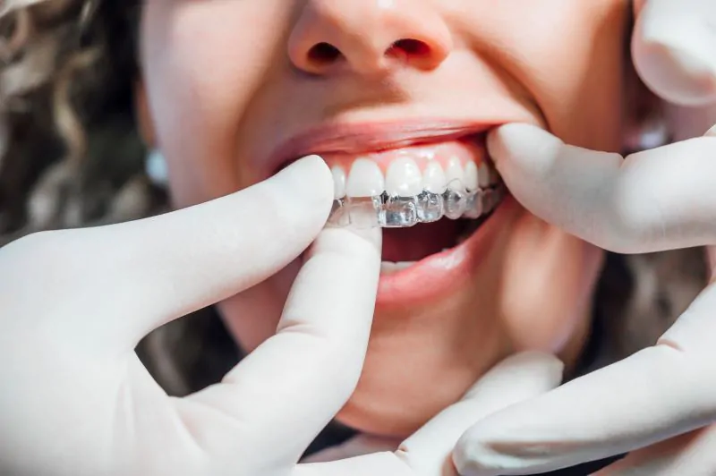 How Clear Aligners Work at Home Guide