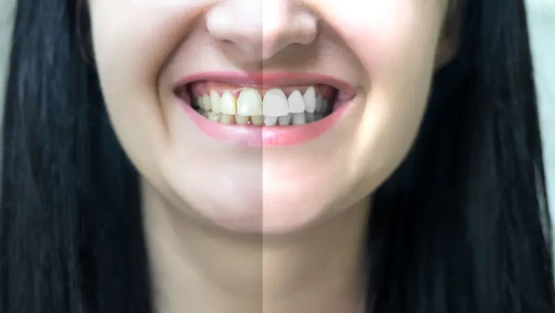 Teeth Whitening in Bali Is It Dangerous