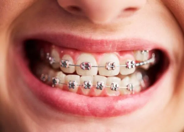 aligner vs behel, mana yang paling ampuh wallpaper