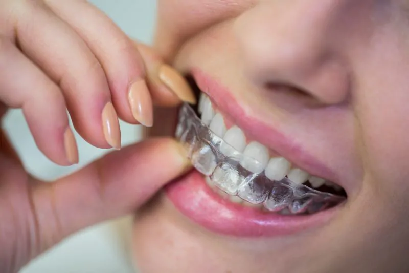aligner vs behel, mana yang paling ampuh